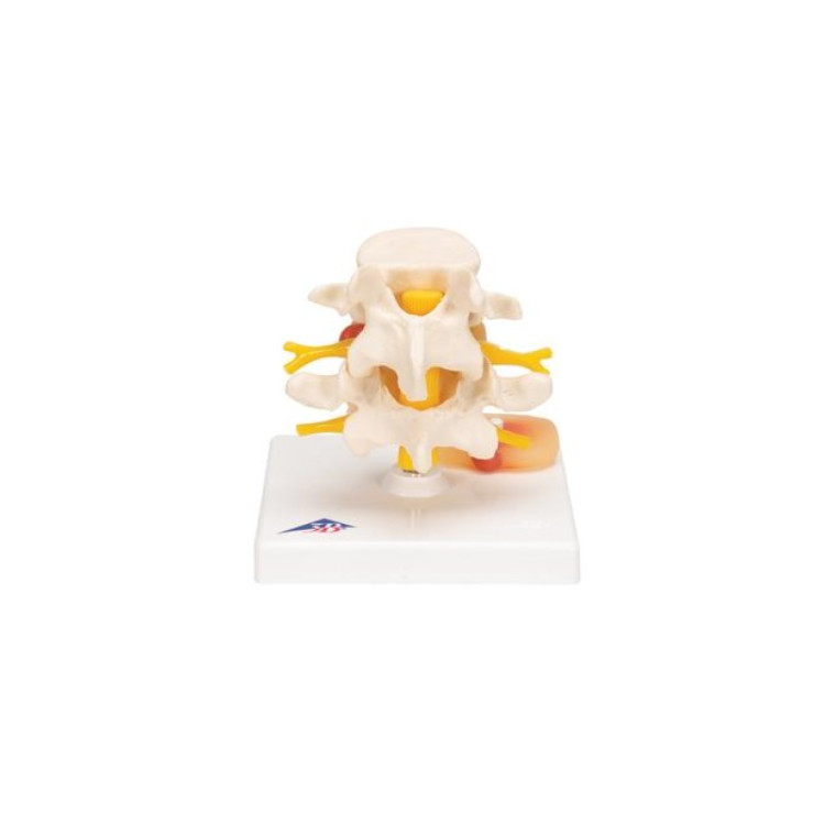 A76 Lumbar Spinal Column with Prolapsed Intervertebral Disc  
