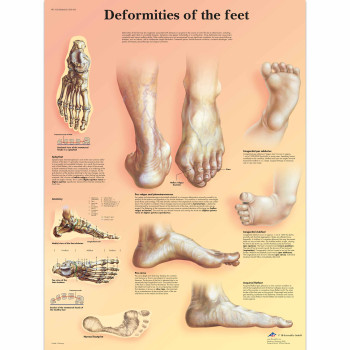 VR1185 Deformities of the feet Poster