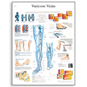 VR1367 Varicose Veins Poster
